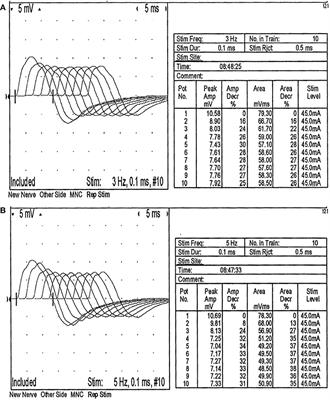 Myasthenia Gravis With Reversible Pyramidal Tract Damage and Pseudo Internuclear Ophthalmoplegia. A Case Report and Literature Review